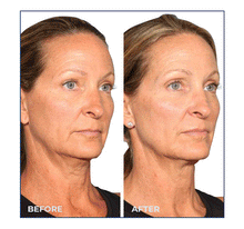 Load image into Gallery viewer, Sofwave - 20% OFF